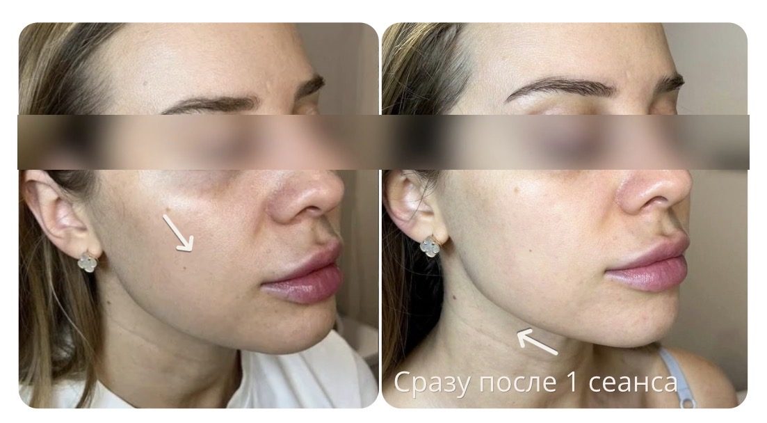 Лицо до и сразу после одного сеанса EMS 3 в 1